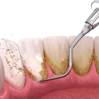 Periodontal Treatment in Modesto, CA