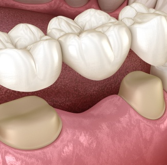 Dental Bridges