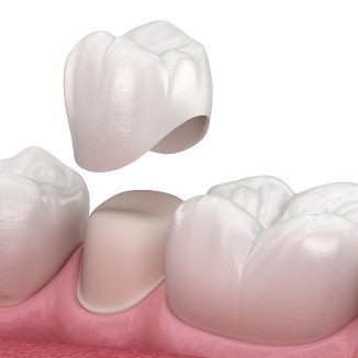 Dental Crowns