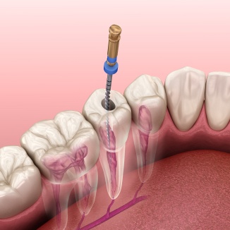 Root Canal Treatment